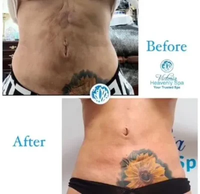 fibrosis treatment houston