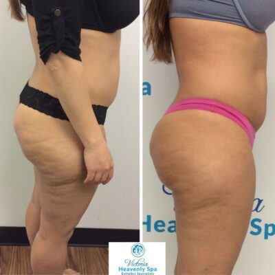 Body Contouring Victoria Heavenly Spa houston medical spa