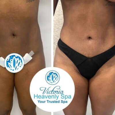 Body Contouring Victoria Heavenly Spa houston medical spa