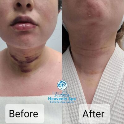 Facial Contouring Victoria Heavenly Spa houston medical spa
