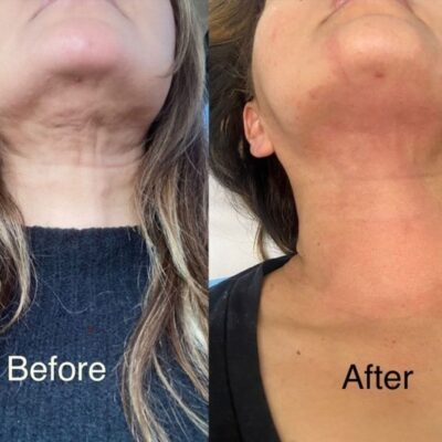 Facial Contouring Victoria Heavenly Spa houston medical spa
