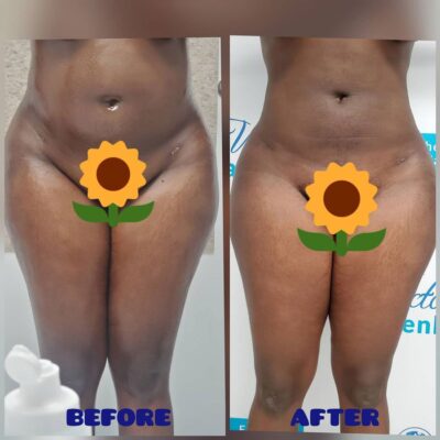 Body Contouring Victoria Heavenly Spa houston medical spa
