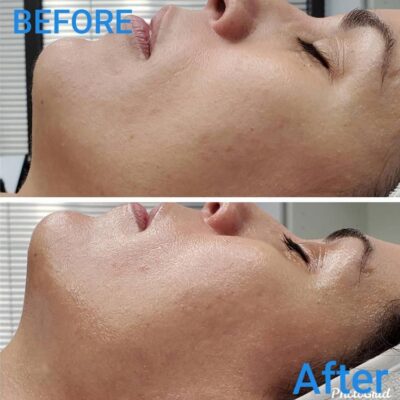 Enlarged pore treatment houston