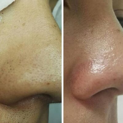 Enlarged pore treatment houston