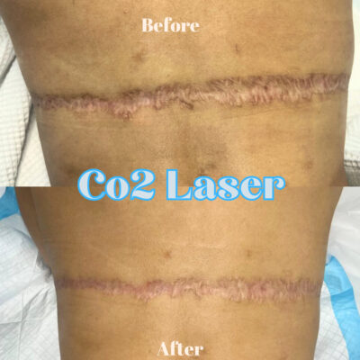 CO2 laser treatment houston