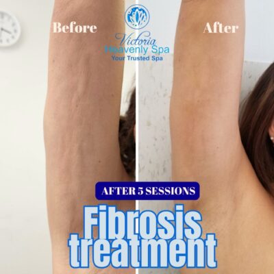 fibrosis treatment arm houston