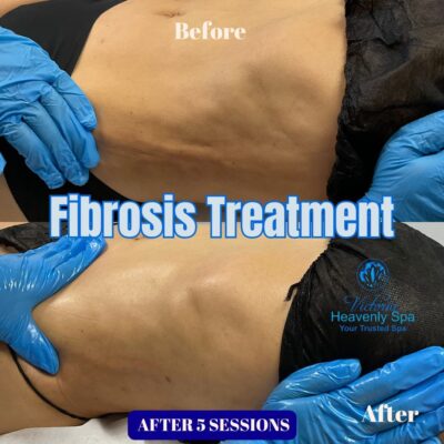 fibrosis treatment corps houston
